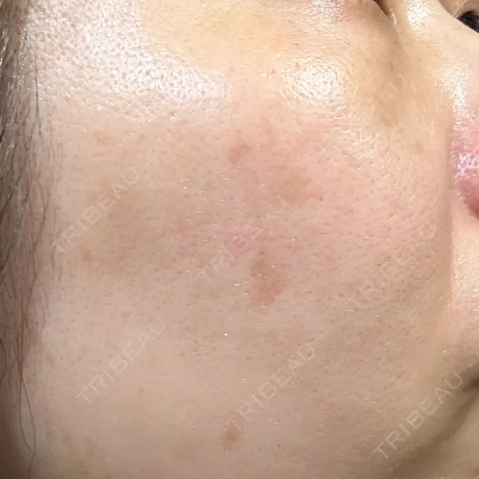 その他（肌） / ピコレーザートーニング（美白・肝斑） SK新宿歌舞伎町美容外科・歯科 AFTER メイン用