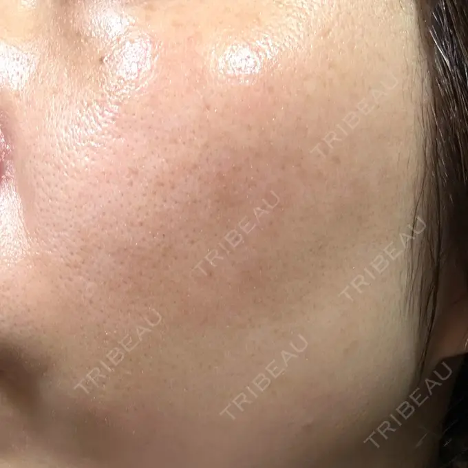 その他（肌） / ピコレーザートーニング（美白・肝斑） SK新宿歌舞伎町美容外科・歯科 DAY 11 メイン用