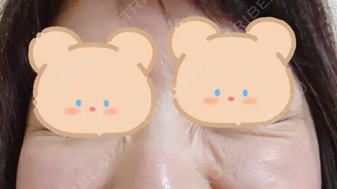 シワ取りボトックス / ボトックス（目尻） 湘南美容クリニック 川崎院 DAY 4 メイン用