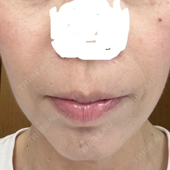 肌ヒアルロン酸注入（たるみ・シワ改善） アリエル美容クリニック 大宮院 DAY 3 メイン用