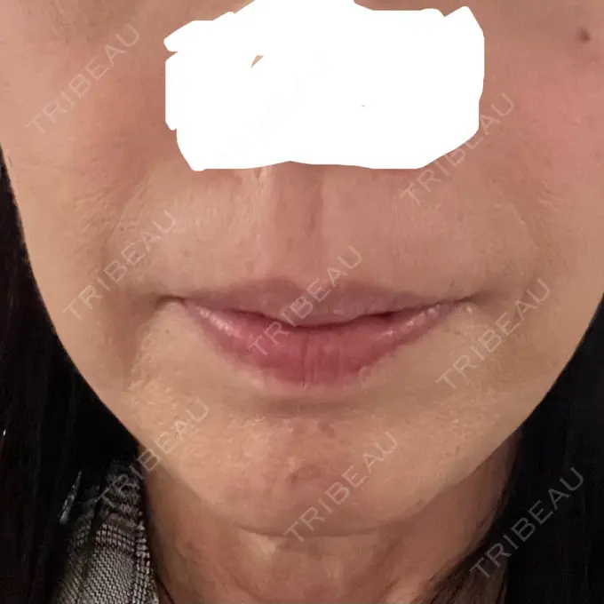 肌ヒアルロン酸注入（たるみ・シワ改善） アリエル美容クリニック 大宮院 DAY 4 メイン用