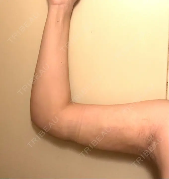 脂肪吸引（二の腕） アムルーズ美容外科クリニック 横浜院 DAY 15 メイン用