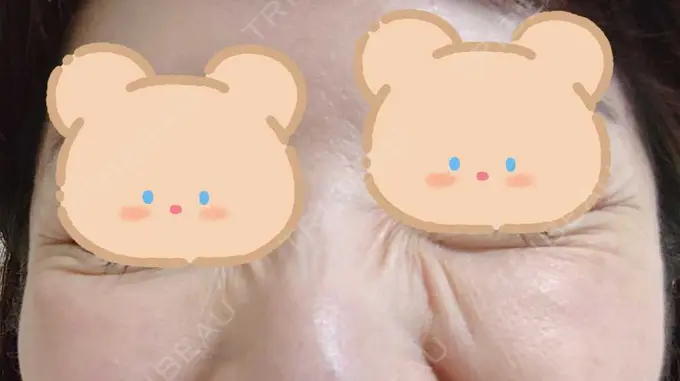 シワ取りボトックス / ボトックス（目尻） 湘南美容クリニック 川崎院 DAY 5 メイン用