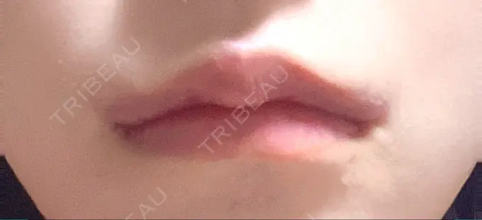 口角挙上 くさのたろうクリニック DAY 10 メイン用