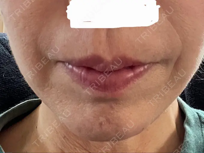 肌ヒアルロン酸注入（たるみ・シワ改善） アリエル美容クリニック 大宮院 DAY 5 メイン用