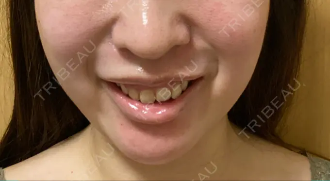 ボトックス（ガミースマイル） 椿クリニック 心斎橋院 DAY 2 メイン用