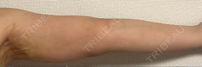 脂肪吸引（二の腕） ルーチェクリニック 銀座院 DAY 19 メイン用