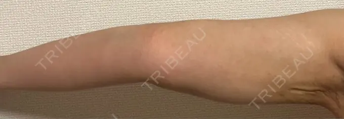 脂肪吸引（二の腕） ルーチェクリニック 銀座院 DAY 19 メイン用