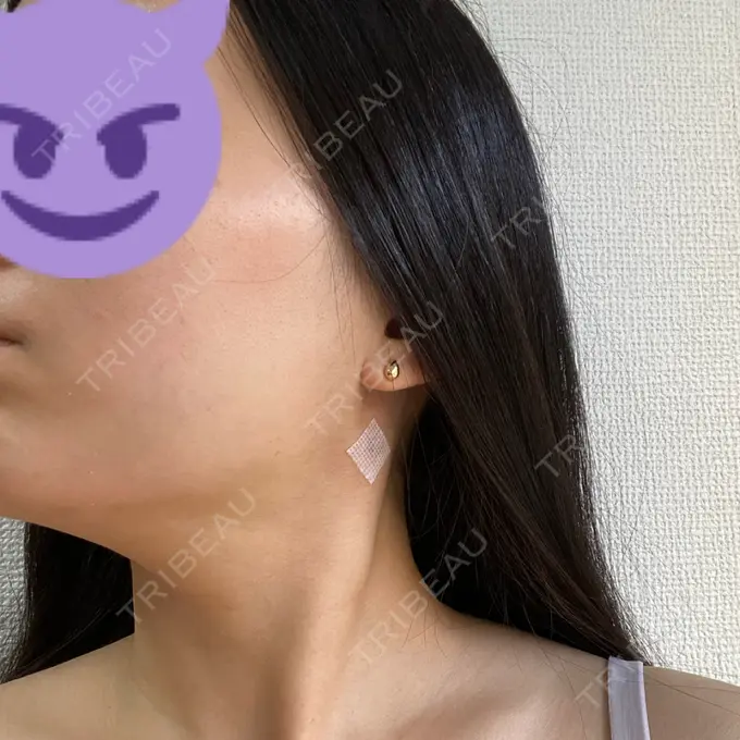 糸リフト / 脂肪吸引（顔） / ボトックス（エラ・小顔） RIVER CLINIC（リバークリニック） DAY 3 メイン用