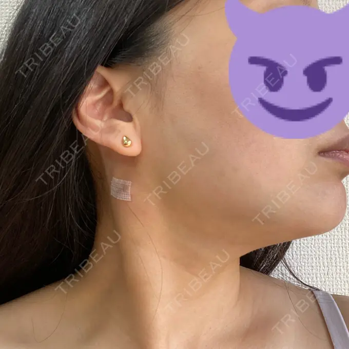 糸リフト / 脂肪吸引（顔） / ボトックス（エラ・小顔） RIVER CLINIC（リバークリニック） DAY 3 メイン用