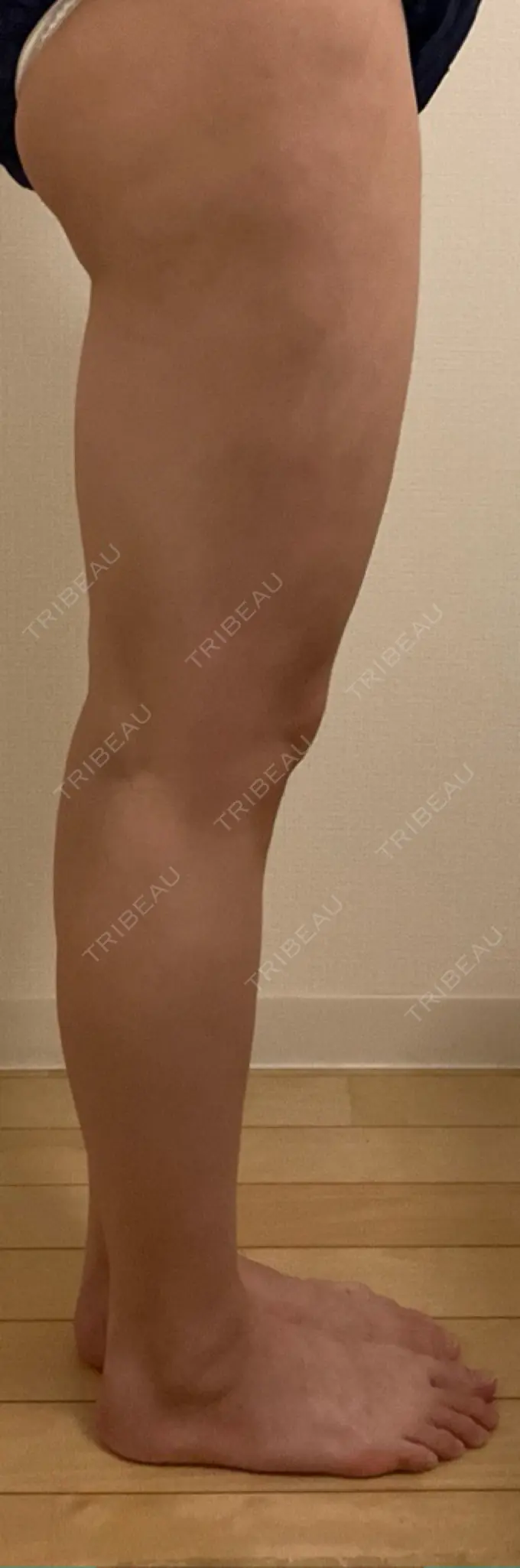 脂肪吸引（脚） ICON CLINIC DAY 38 メイン用