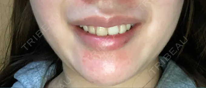 ボトックス（ガミースマイル） 椿クリニック 心斎橋院 DAY 3 メイン用