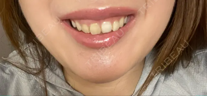 ボトックス（ガミースマイル） 椿クリニック 心斎橋院 DAY 4 メイン用