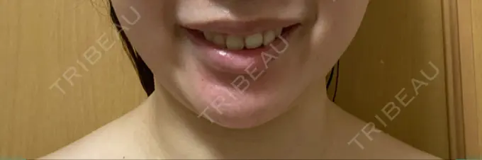 ボトックス（ガミースマイル） 椿クリニック 心斎橋院 DAY 5 メイン用