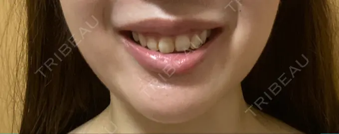 ボトックス（ガミースマイル） 椿クリニック 心斎橋院 DAY 6 メイン用