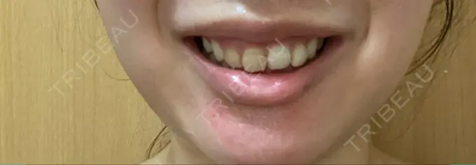 ボトックス（ガミースマイル） 椿クリニック 心斎橋院 DAY 7 メイン用