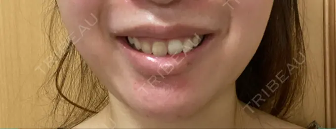 ボトックス（ガミースマイル） 椿クリニック 心斎橋院 DAY 8 メイン用