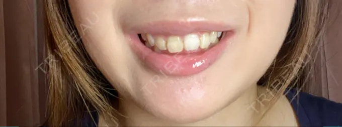 ボトックス（ガミースマイル） 椿クリニック 心斎橋院 DAY 9 メイン用