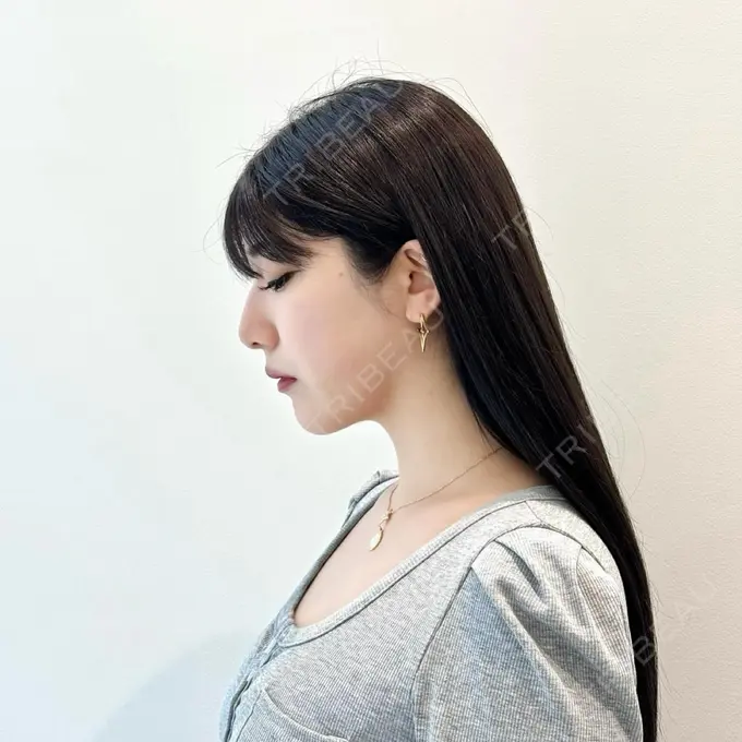 脂肪吸引（顔） / ジョールファット除去 / ヒアルロン酸注入（あご） yuzawa clinic AFTER メイン用