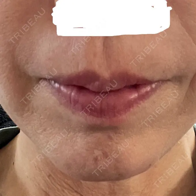 肌ヒアルロン酸注入（たるみ・シワ改善） アリエル美容クリニック 大宮院 DAY 6 メイン用