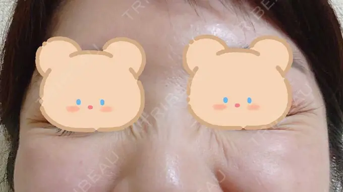 シワ取りボトックス / ボトックス（目尻） 湘南美容クリニック 川崎院 DAY 7 メイン用