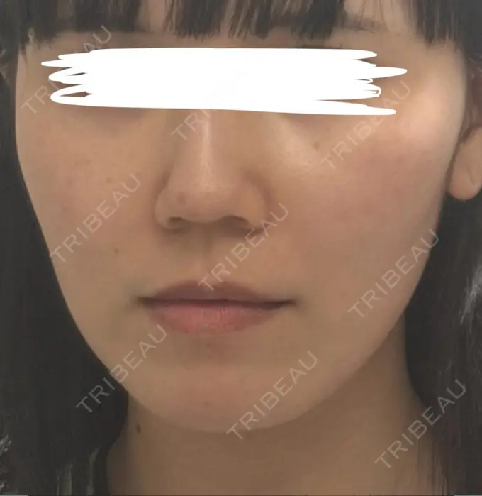 糸リフト / ヒアルロン酸注入（鼻翼基部） 吉祥寺アイビークリニック DAY 4 メイン用