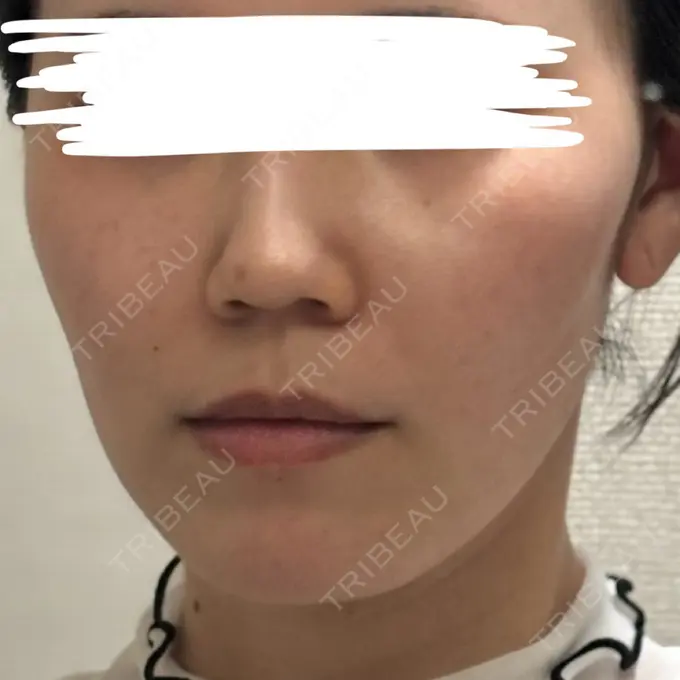 糸リフト / ヒアルロン酸注入（鼻翼基部） 吉祥寺アイビークリニック DAY 2 メイン用