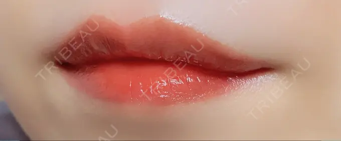 ボトックス（人中） veary clinic AFTER メイン用