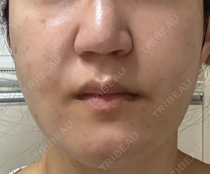 脂肪吸引（顔） スノウ（Snow）整形外科 DAY 21 メイン用