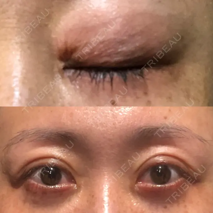 二重埋没 / 目元修正 新宿TAクリニック AFTER メイン用