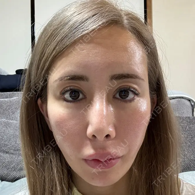 糸リフト / 脂肪吸引（顔） / ヒアルロン酸注入（あご） THE FIRST CLINIC 多摩センター院 AFTER メイン用