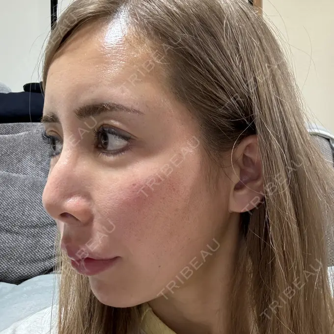 糸リフト / 脂肪吸引（顔） / ヒアルロン酸注入（あご） THE FIRST CLINIC 多摩センター院 DAY 7 メイン用