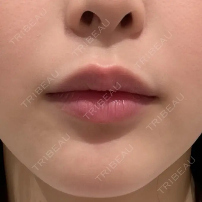 ヒアルロン酸注入（唇） ziz CLINIC DAY 0 メイン用