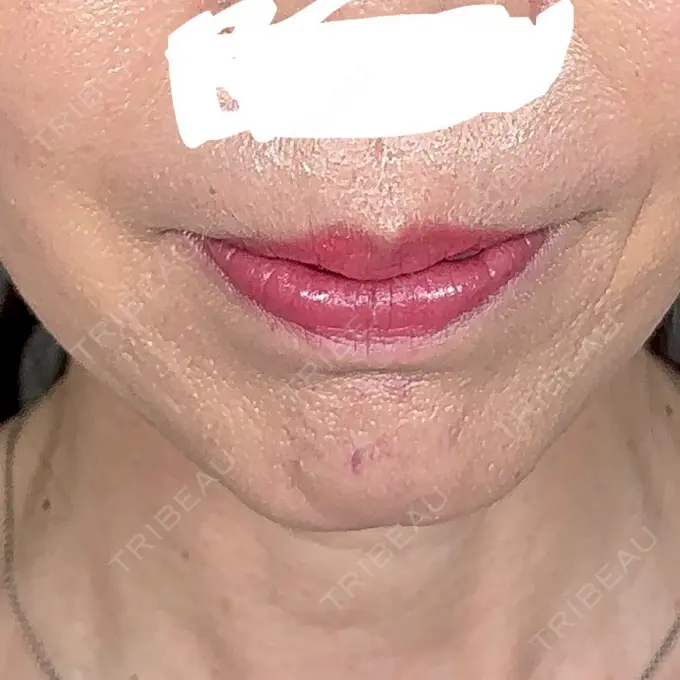 肌ヒアルロン酸注入（たるみ・シワ改善） アリエル美容クリニック 大宮院 AFTER メイン用