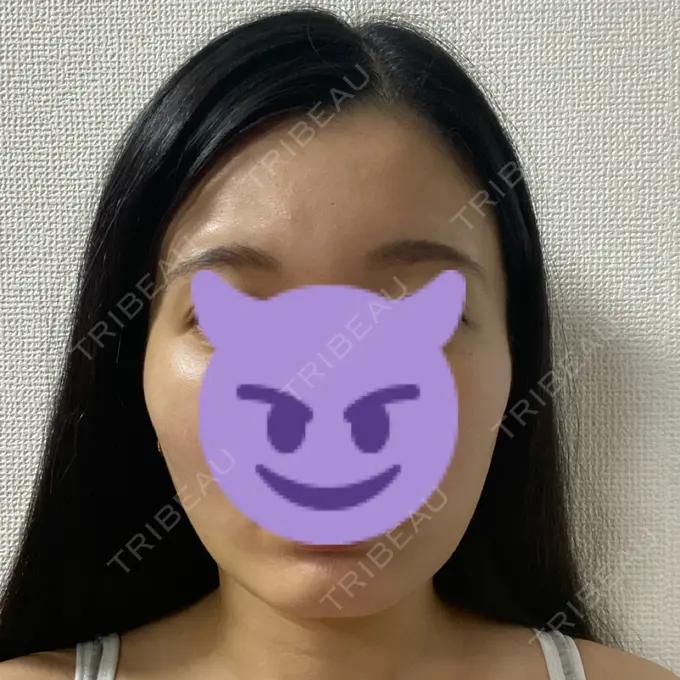 糸リフト / 脂肪吸引（顔） / ボトックス（エラ・小顔） RIVER CLINIC（リバークリニック） DAY 4 メイン用