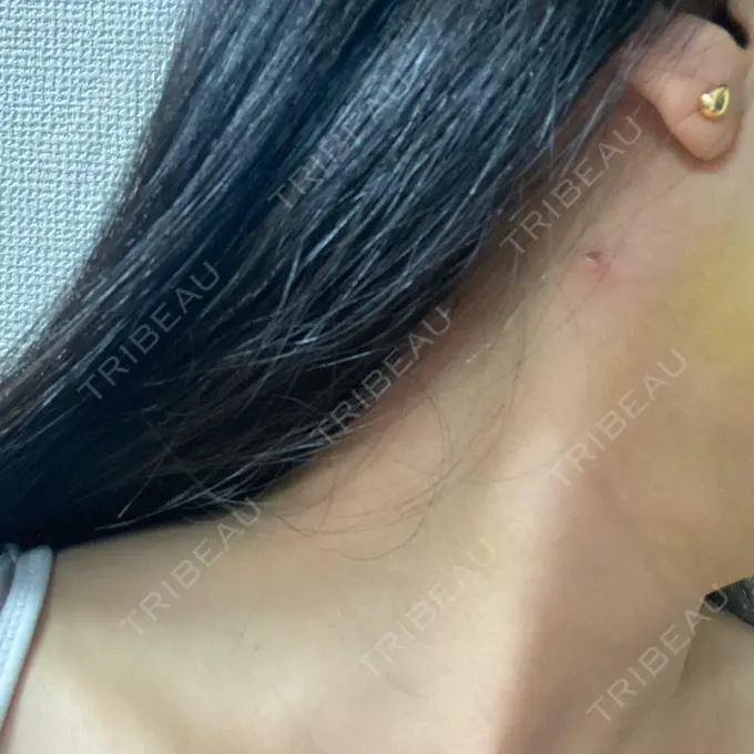 糸リフト / 脂肪吸引（顔） / ボトックス（エラ・小顔） RIVER CLINIC（リバークリニック） DAY 4 メイン用