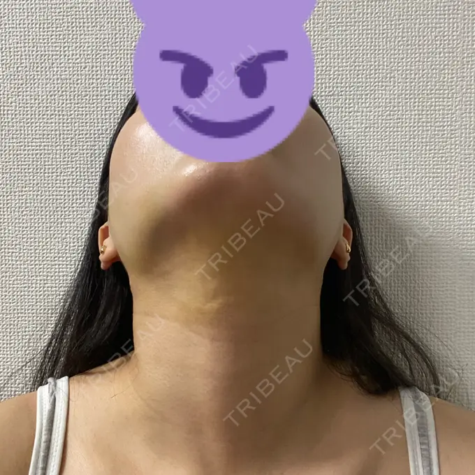 糸リフト / 脂肪吸引（顔） / ボトックス（エラ・小顔） RIVER CLINIC（リバークリニック） DAY 4 メイン用