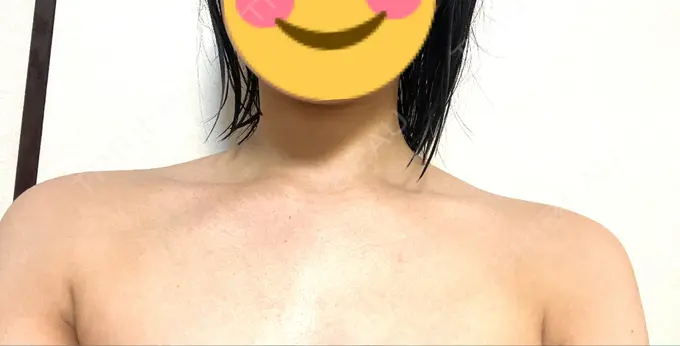 ボトックス（肩） MYCLINIC 西新宿 DAY 2 メイン用