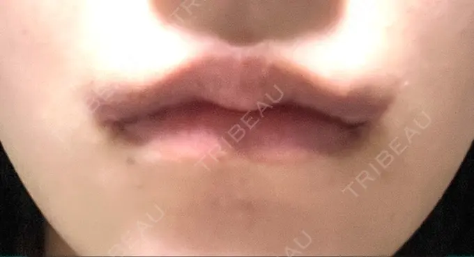 口角挙上 くさのたろうクリニック DAY 13 メイン用