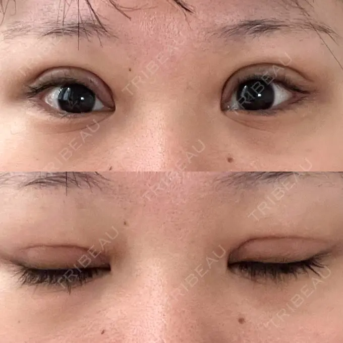 二重切開 / 眼瞼下垂（切開） エターナル美容クリニック DAY 19 メイン用