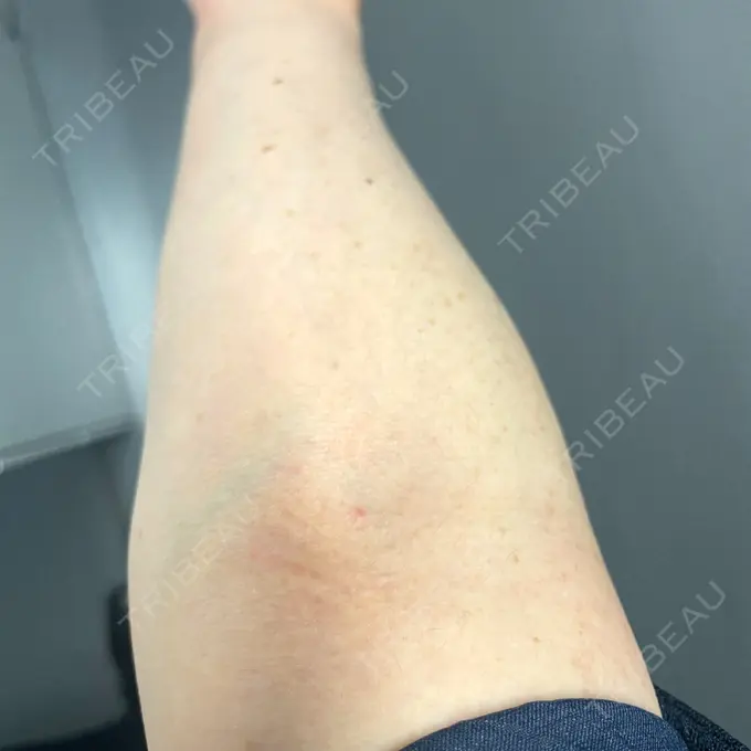 白玉点滴・注射 美容皮膚科エルムクリニック 麻布院 AFTER メイン用