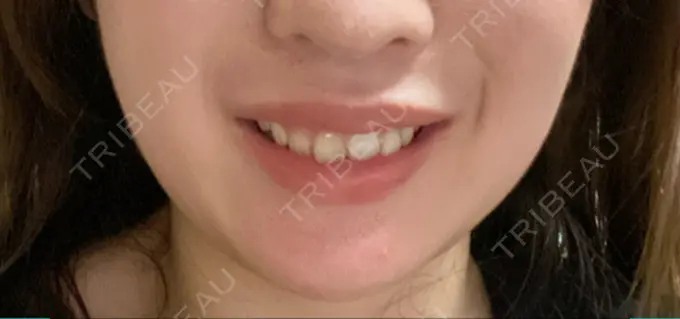 ボトックス（ガミースマイル） 椿クリニック 心斎橋院 AFTER メイン用