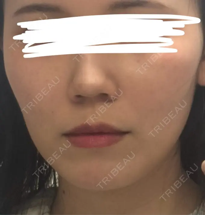 糸リフト / ヒアルロン酸注入（鼻翼基部） 吉祥寺アイビークリニック AFTER メイン用