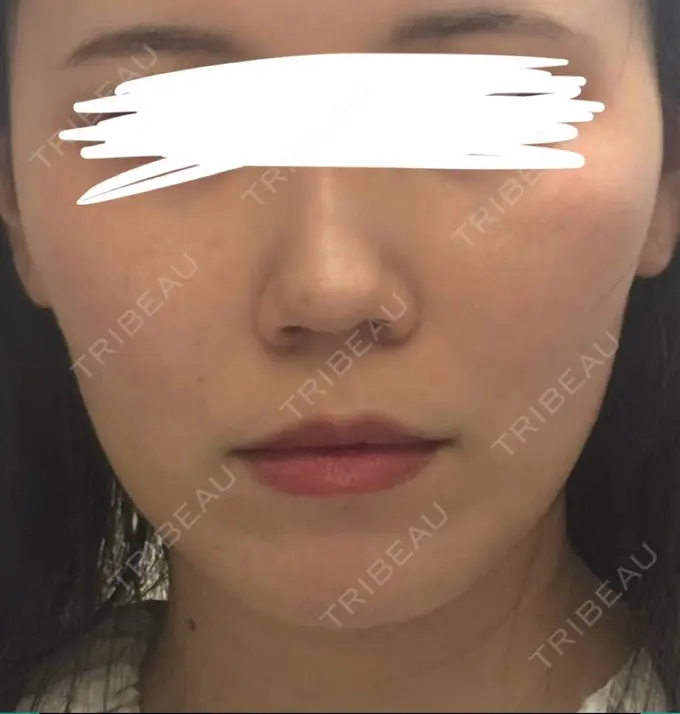 糸リフト / ヒアルロン酸注入（鼻翼基部） 吉祥寺アイビークリニック DAY 6 メイン用