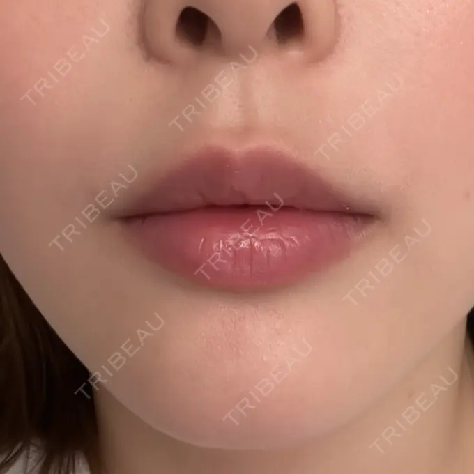 ヒアルロン酸注入（唇） ziz CLINIC DAY 1 メイン用