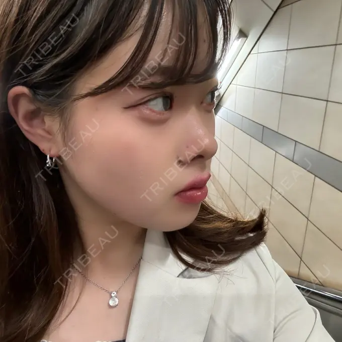 ヒアルロン酸注入（涙袋） 吉祥寺アイビークリニック DAY 0 メイン用