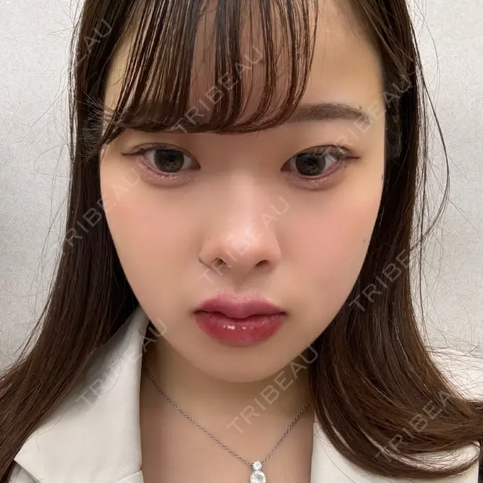 ヒアルロン酸注入（涙袋） 吉祥寺アイビークリニック DAY 0 メイン用