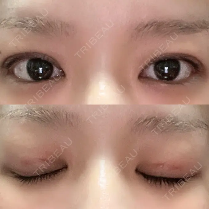 二重埋没 ルネッサンス美容外科医院 神戸院 DAY 1 メイン用