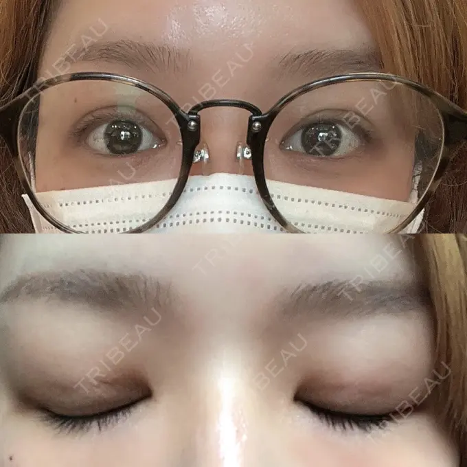 二重埋没 ルネッサンス美容外科医院 神戸院 DAY 2 メイン用