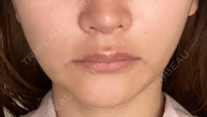 ヒアルロン酸注入（鼻翼基部） THE FIRST CLINIC 町田院 AFTER メイン用